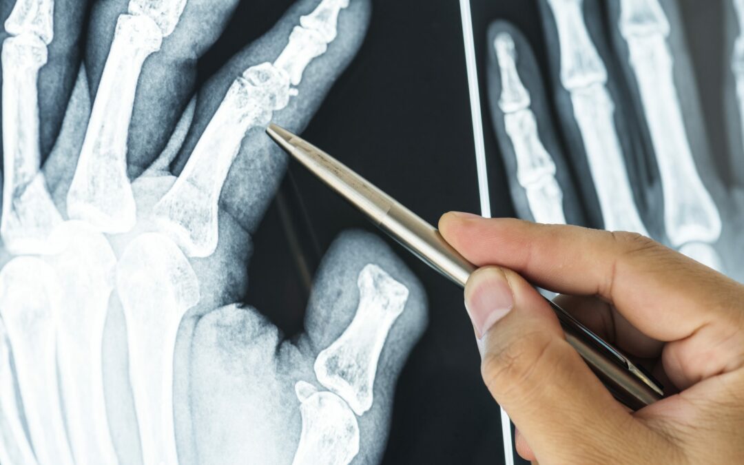 How to Heal Broken Bones and Fractures: A Guide to Aftercare
